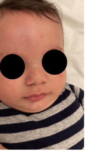 A Newly Documented Rare Case of Pachyonychia Congenita II in a Three-Month-Old Baby.