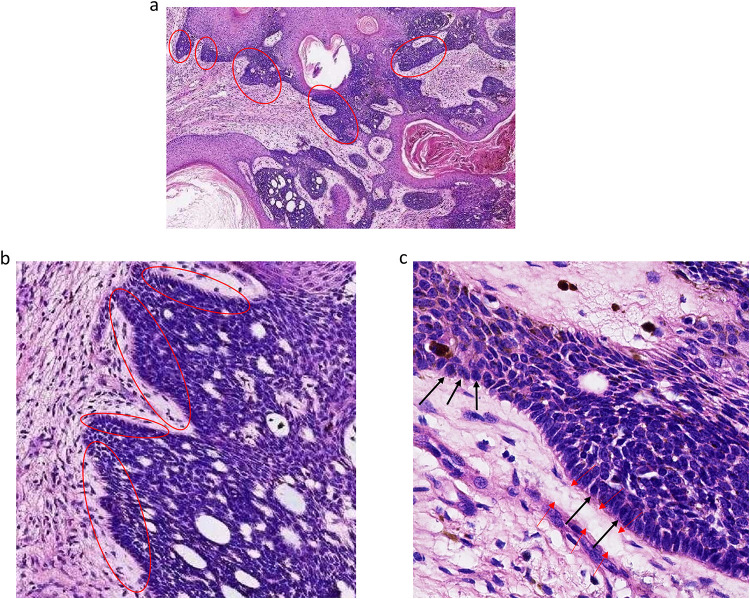 Basal Cell Carcinoma Arising Within a Favre-Racouchot Syndrome Lesion: A Rare Case and Literature Review.