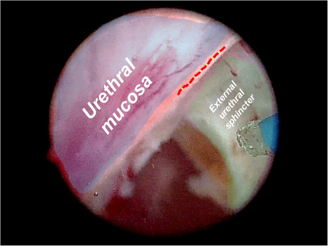 "Double rings" En-bloc technique with early anatomical apical release in thuflep for the patients with large glands (≥ 80 mL): the outcomes from single center.
