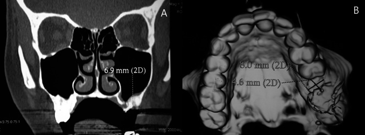 Clinical and radiographic evaluation of the efficacy of vital- os bone cement in stabilizing an autogenous monocortical bone graft in the repair of oroantral fistula (a comparative study).
