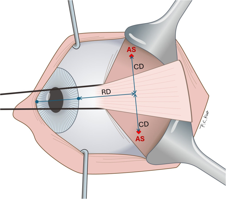 Comparison of different positioning techniques for reduction of induced vertical deviation following Nishida procedure for the treatment of sixth nerve palsy.