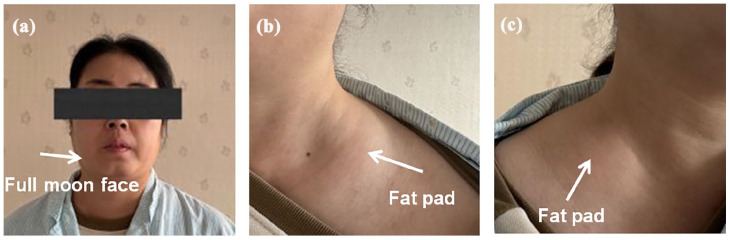 Kangbo Knife Cryoablation for the Treatment of Functional Adrenal Tumors.
