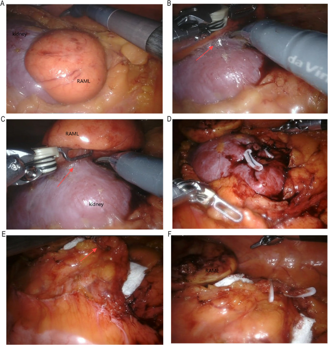Off-clamp robot-assisted nephron-sparing surgery is associated with less operative time and potential for vascular complication in the treatment of renal angiomyolipoma > 4 cm: a comparative study.