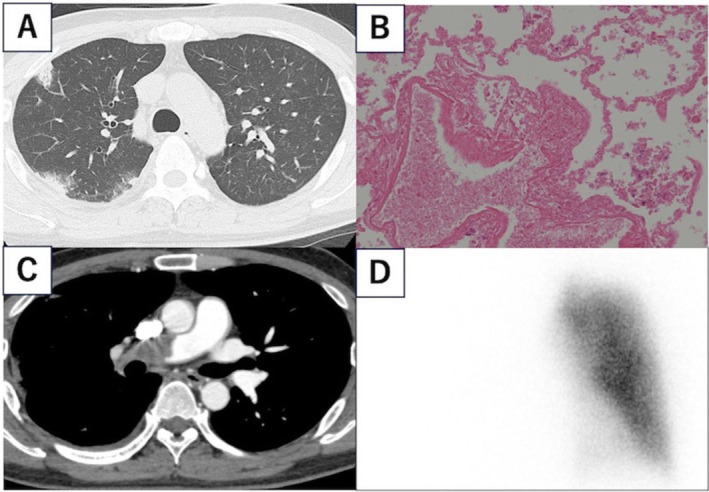 A Case of Nontuberculous Mycobacterial Pulmonary Disease Complicating Massive Pulmonary Embolism.