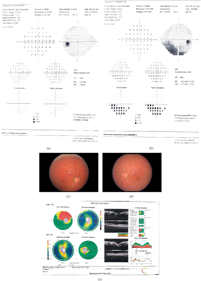 Neuro-Ophthalmic Manifestation Associated With COVID-19 in a Tertiary Eye Center in Nepal.