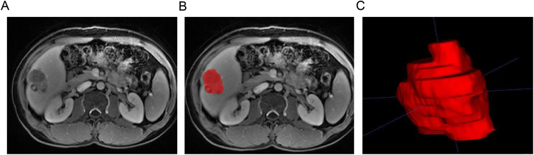 Development and Validation of a Radiomics Nomogram Based on Magnetic Resonance Imaging and Clinicoradiological Factors to Predict HCC TACE Refractoriness.