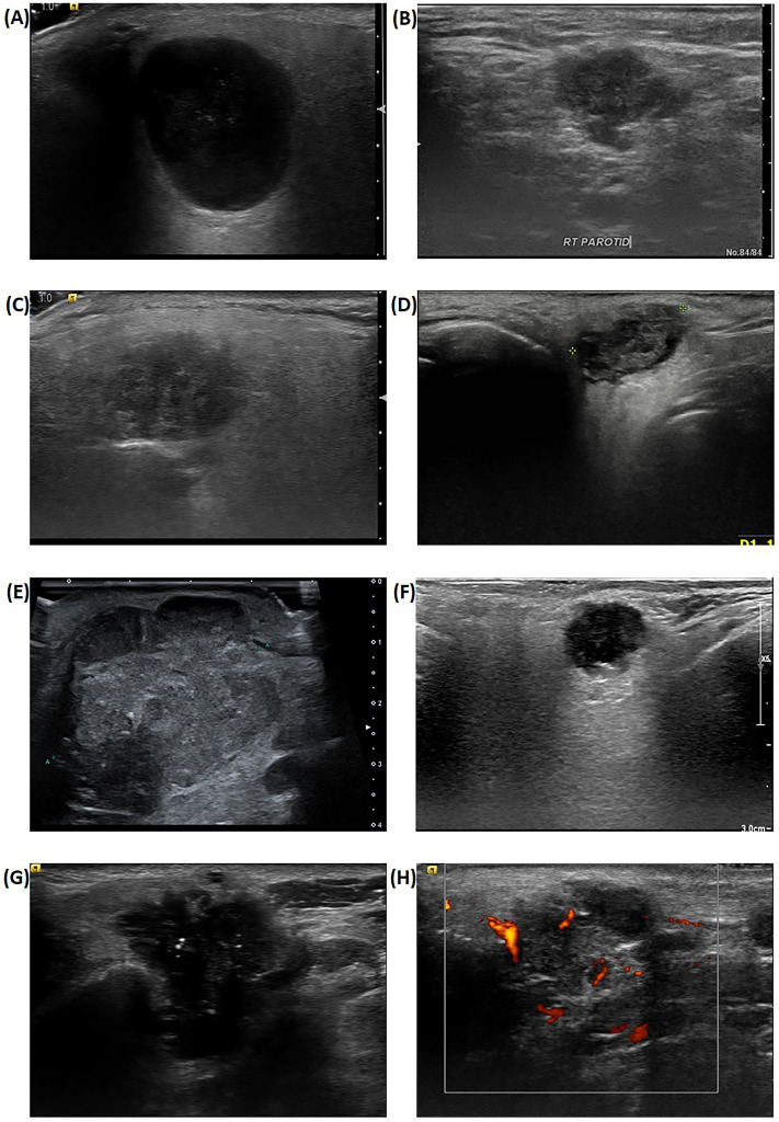 Ultrasonographic findings as a prognostic factor in parotid cancer.