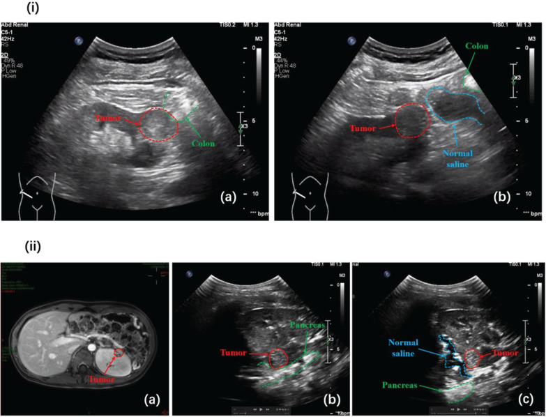 Risk-adjusted trifecta outcomes in ultrasound-guided RFA of T1a renal masses: experi-ence from a large tertiary cancer center.