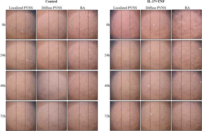 IFNγ production during cell interactions distinguishes localized from diffuse pigmented villonodular synovitis and rheumatoid arthritis.