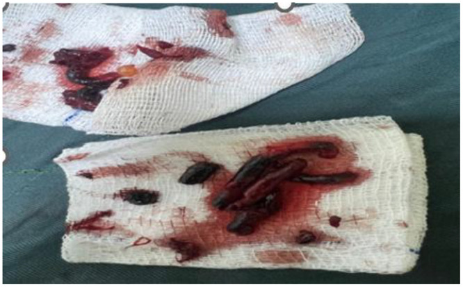 Challenges in Diagnosis and Management of Acute Limb Ischemia 30 Days Postpartum in Lithotomy Position: A Case Report from Somalia Leading to Bilateral Lower Limb Amputation.