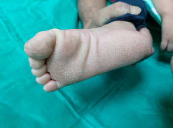 A case report of palmoplantar keratoderma in a 3-year-old girl: A structured approach in primary care settings.