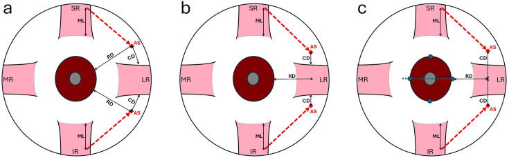 Comparison of different positioning techniques for reduction of induced vertical deviation following Nishida procedure for the treatment of sixth nerve palsy.