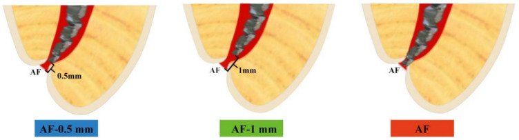 The effect of three different apical termini on postoperative pain in teeth with irreversible pulpitis: a prospective clinical study.
