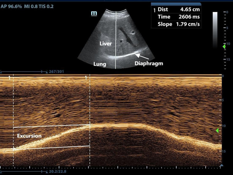 Diaphragm Assessment by Multimodal Ultrasound Imaging in Patients with Chronic Obstructive Pulmonary Disease: A Prospective Observational Study.