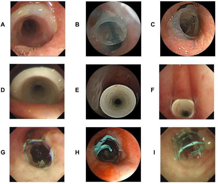 Science progress distinguishing different types of airway stents under bronchoscopy by artificial intelligence.