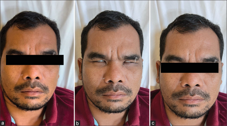 Navigating the complexities of bilateral facial nerve palsy: A case report.