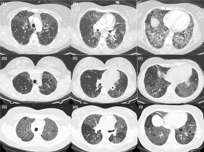 <i>ABCA3</i> Surfactant-Related Gene Variant Associated Interstitial Lung Disease in Adults: A Case Series and Review of the Literature.