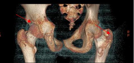 Long-Term Consequences of Misdiagnosis of Parathyroid Adenomas in Pediatric Patients.
