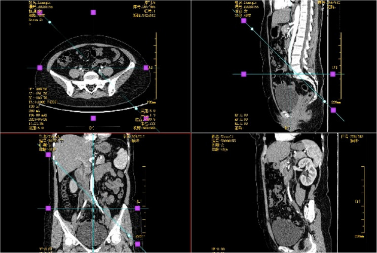 Ureteral endometriosis post-hysterectomy for adenomyosis: a case report and literature review.