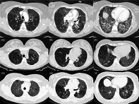 <i>ABCA3</i> Surfactant-Related Gene Variant Associated Interstitial Lung Disease in Adults: A Case Series and Review of the Literature.