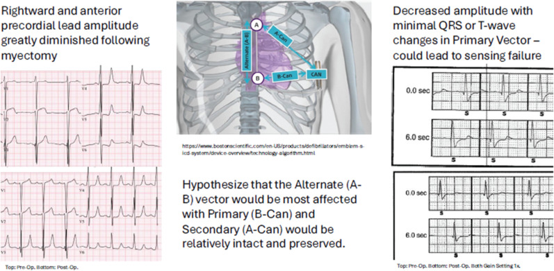 Preserved Subcutaneous Implantable Cardioverter-defibrillator Function Following Septal Myectomy and Coronary Artery Unroofing in a Pediatric Patient with Severe Hypertrophic Cardiomyopathy.
