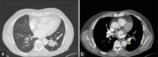 Prevention of intraoperative bleeding during thoracoscopic left lower lobectomy; an unnecessary occlusion of pulmonary artery and vein.
