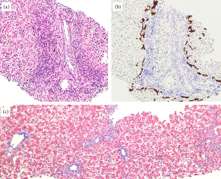 A Rare Case of Neonatal Cholestasis Linked to FOCAD Gene Variants: Exploring the Variable Phenotypic Presentation and Its Implications.