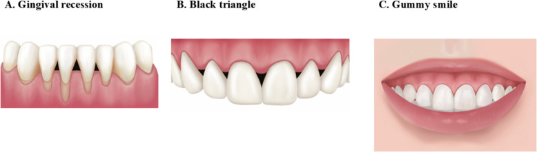Pink esthetic treatment of gingival recession, black triangle, and gummy smile: a narrative review.