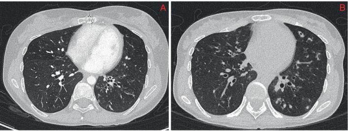 <i>Mycobacterium abscessus</i> Pulmonary Disease in a Myasthenia Gravis Patient: A Case Report.