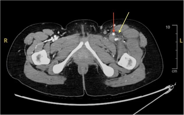 Case report: may-Thurner syndrome: early diagnosis and intervention in a young healthy woman.