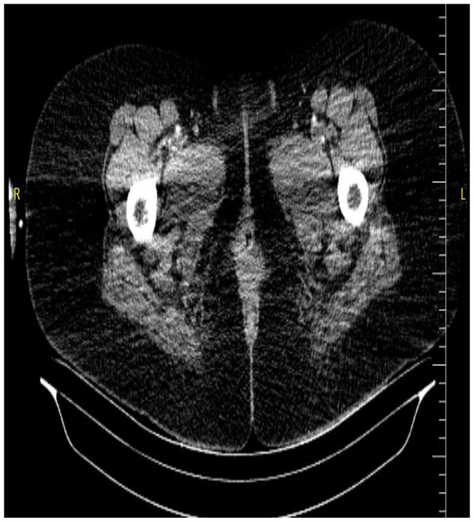 Challenges in Diagnosis and Management of Acute Limb Ischemia 30 Days Postpartum in Lithotomy Position: A Case Report from Somalia Leading to Bilateral Lower Limb Amputation.