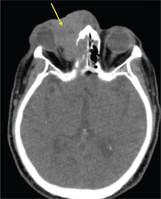 Skin Erosion on the Nasal Root with Marked Right Eyelid Swelling: A Quiz.