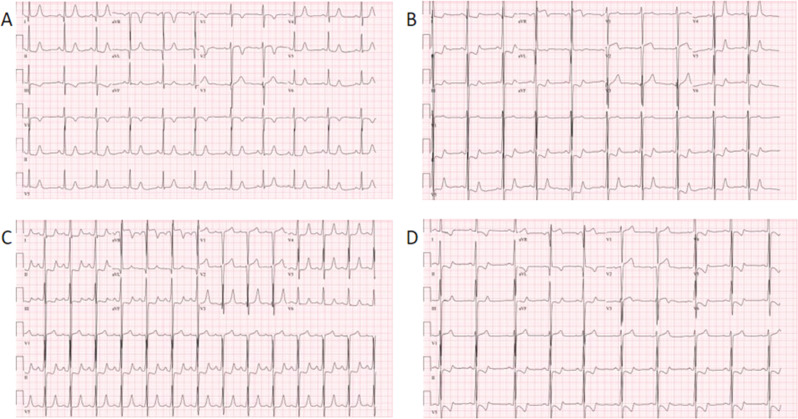 Preserved Subcutaneous Implantable Cardioverter-defibrillator Function Following Septal Myectomy and Coronary Artery Unroofing in a Pediatric Patient with Severe Hypertrophic Cardiomyopathy.