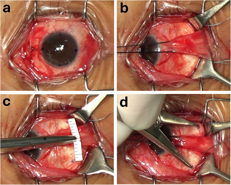 Comparison of different positioning techniques for reduction of induced vertical deviation following Nishida procedure for the treatment of sixth nerve palsy.