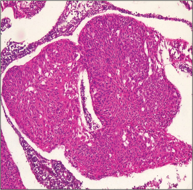 Premalignant and Malignant Ocular Surface Squamous Cell Neoplasia: A Retrospective Hospital-Based Study Spanning 18 Years.