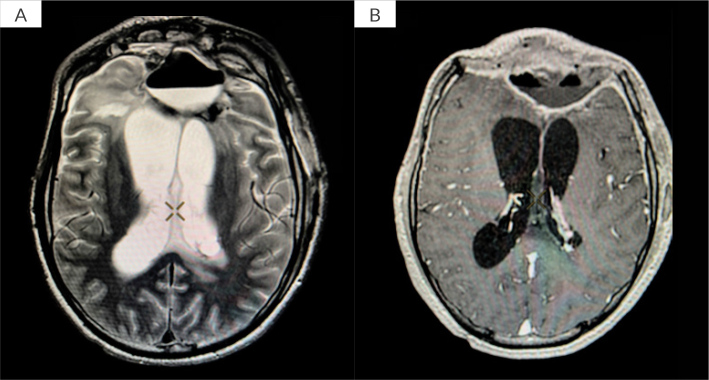 Continuous Irrigation for Refractory Multidrug-Resistant Brain Abscess in two Patients.