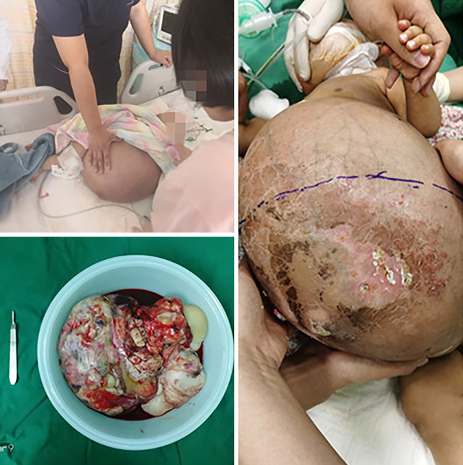 Clinical insights from the management of a giant immature teratoma in an infant-a case report.