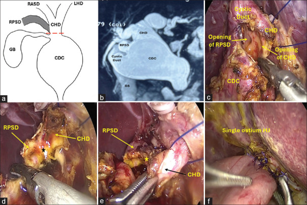Laparoscopic management of variant ductal and vascular anatomy in children with choledochal cysts.