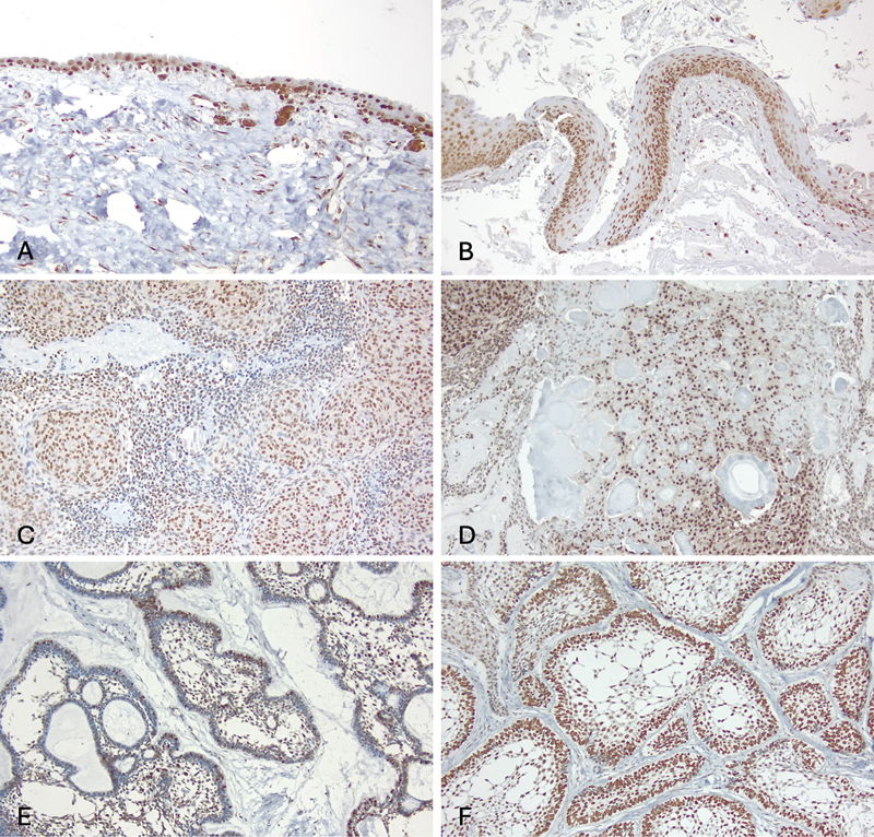 Histone H3K9 Methylation Is Differentially Modified in Odontogenic Cyst and Tumors.