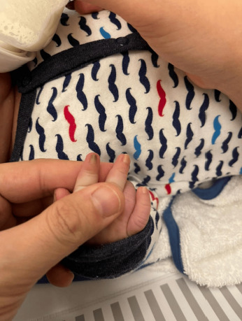A Newly Documented Rare Case of Pachyonychia Congenita II in a Three-Month-Old Baby.