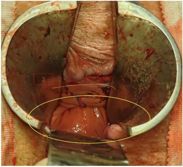Early results of modified anorectal mucopexy and hemorrhoidoplasty with transanal suture: a 21 patient case report of "Salinas-Cabrera procedure".