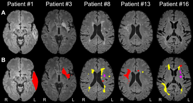 Association of white matter injury and neuroinflammation in the post-acute phase after ischemic stroke using [<sup>18</sup>F]FEPPA-PET/MRI.