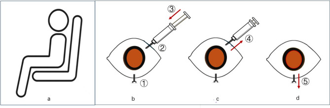 Modified two-needle technique of air/fluid exchange for in-office treatment of unhealed macular hole.
