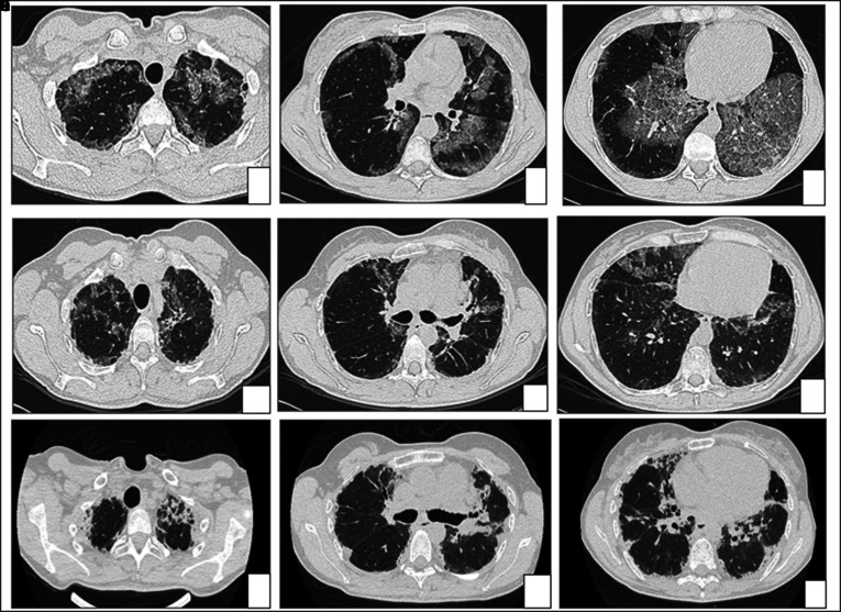 The dark side of pulmonary alveolar proteinosis.