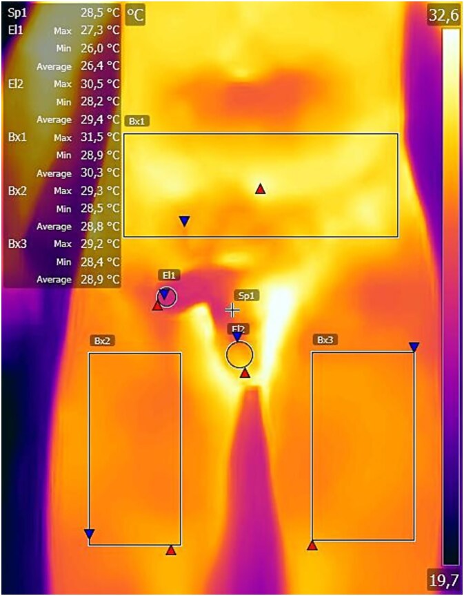 The effect of a single functional neurology session on thermography of the genital region and sexual function in patients with premature ejaculation.
