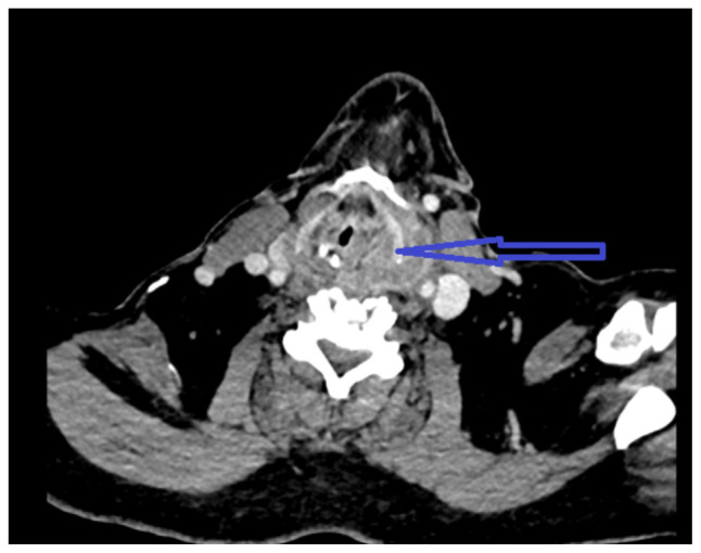 Deep Neck Space Infection as a Complication of Transesophageal Echocardiogram for Atrial Flutter Ablation.