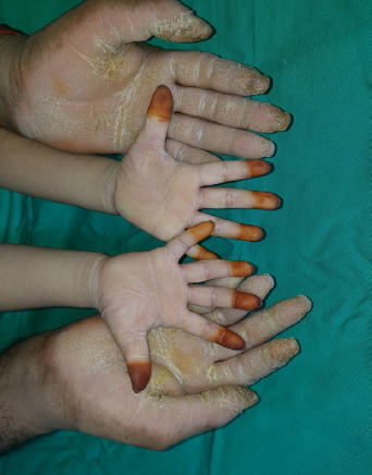 A case report of palmoplantar keratoderma in a 3-year-old girl: A structured approach in primary care settings.