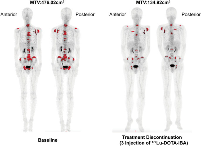 The radiological response of patients with advanced bone metastases to lutetium-177-labeled DOTA-ibandronic acid assessed by metabolic tumor volume.
