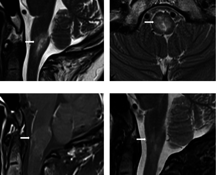 Brainstem Encephalitis as an Atypical Neurologic Complication Following Kikuchi-Fujimoto Disease.