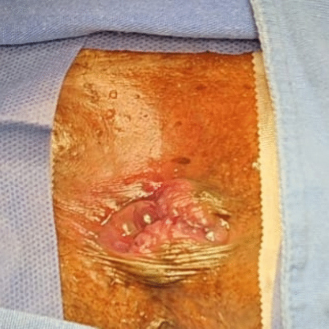 Early results of modified anorectal mucopexy and hemorrhoidoplasty with transanal suture: a 21 patient case report of "Salinas-Cabrera procedure".
